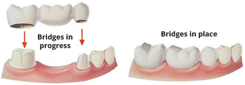 crowns and bridgework-image